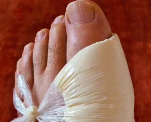 Living with Gout: Diet and Lifestyle Changes